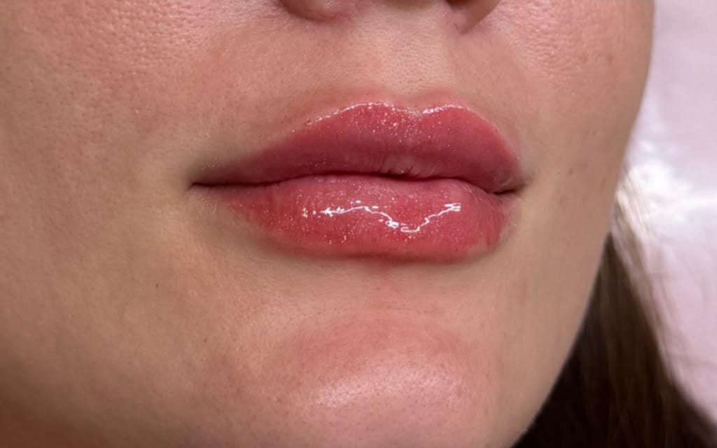 Preenchimento facial: como funciona, tipos e cuidados