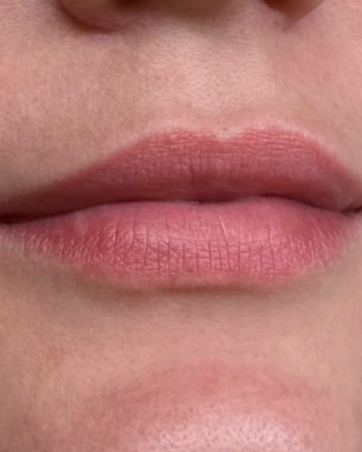 Antes, preenchimento labial