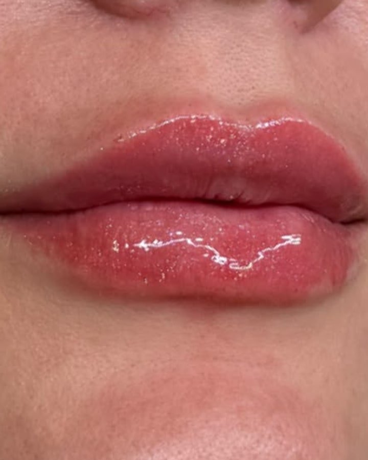 Depois, preenchimento labial