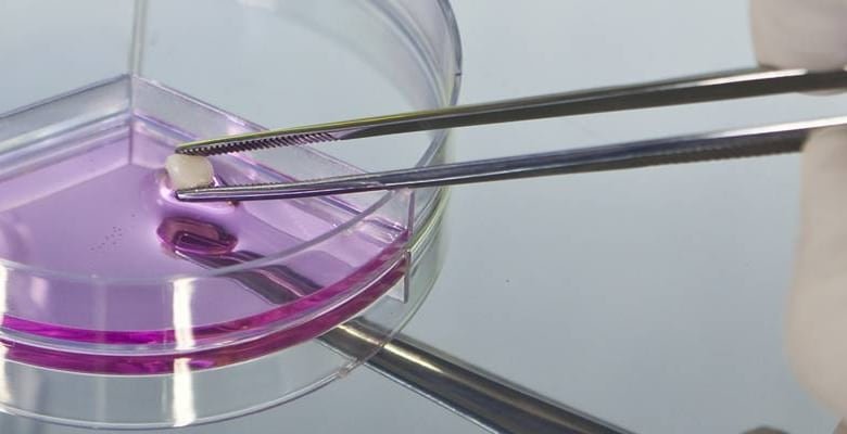 Dente de leite sendo coletado com pinça para células-tronco