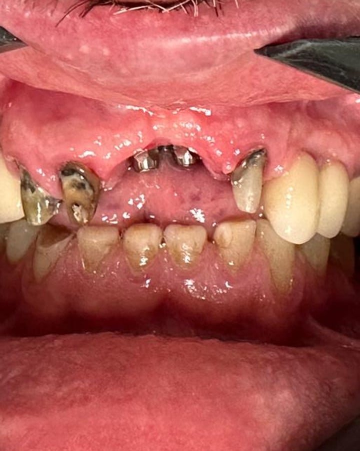 Antes, implante dentário