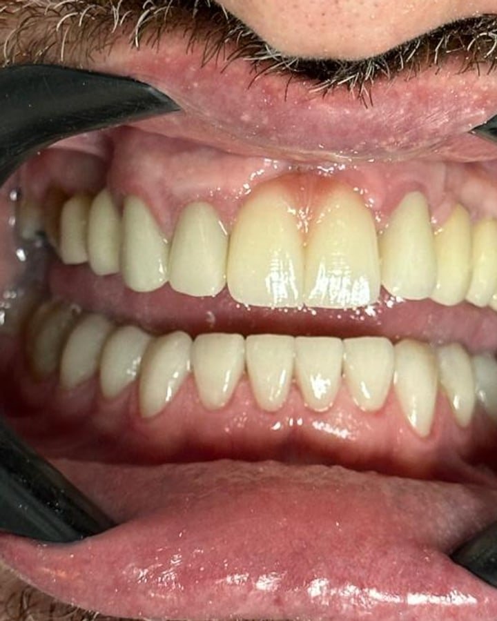 Depois, implante dentário