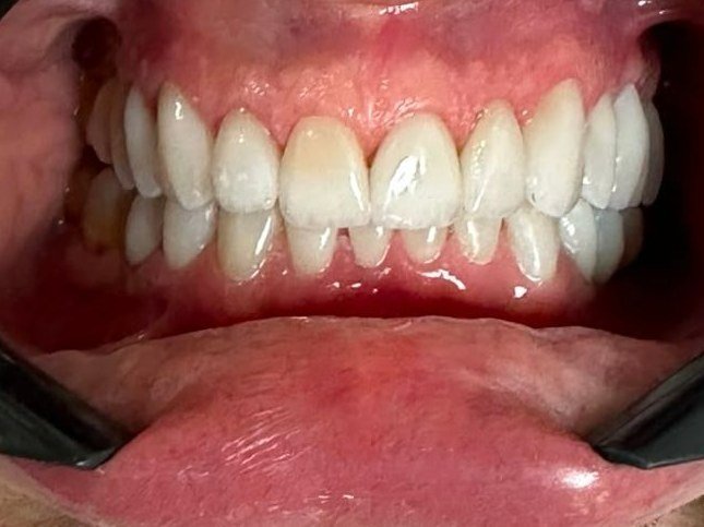 Depois do tratamento com lentes de porcelana