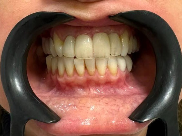 Antes do tratamento com facetas de porcelana