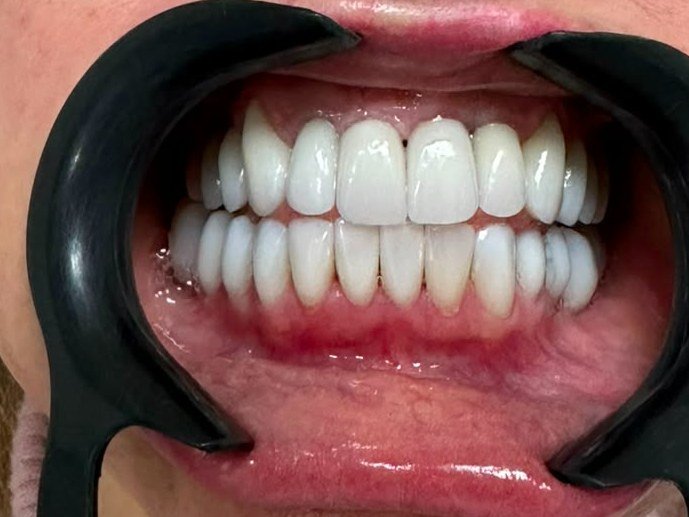 Depois do tratamento com facetas de porcelana